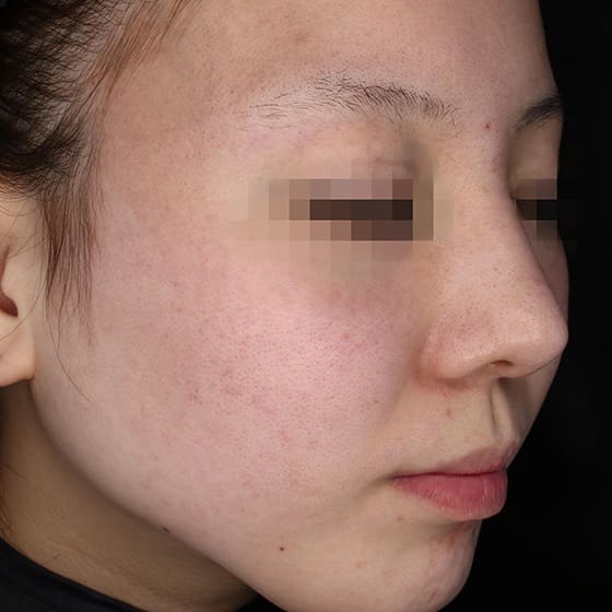 PicoSure Before and After - Case -1, Image 2 - Female, age 25 – 34 - Montréal & Saint-Sauveur, QC - Clinique AG