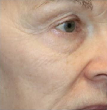 TempSure Envi Before and After - Case 3, Image 2 - Female, age 55 – 64 - Montréal & Saint-Sauveur, QC - Clinique AG