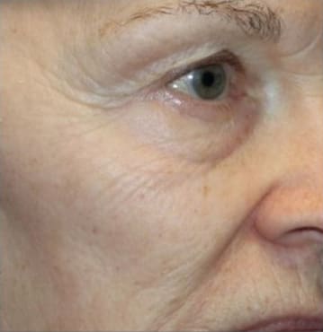 TempSure Envi Before and After - Case 3, Image 1 - Female, age 55 – 64 - Montréal & Saint-Sauveur, QC - Clinique AG