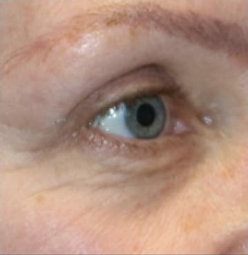 TempSure Envi Before and After - Case -1, Image 2 - Female, age 45 – 54 - Montréal & Saint-Sauveur, QC - Clinique AG