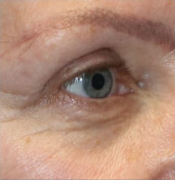 TempSure Envi Before and After - Case -1, Image 1 - Female, age 45 – 54 - Montréal & Saint-Sauveur, QC - Clinique AG