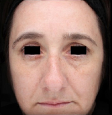 TempSure Envi Before and After - Case 4, Image 4 - Female, age 45 – 54 - Montréal & Saint-Sauveur, QC - Clinique AG