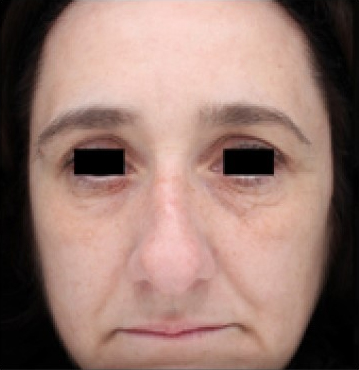 TempSure Envi Before and After - Case 4, Image 3 - Female, age 45 – 54 - Montréal & Saint-Sauveur, QC - Clinique AG