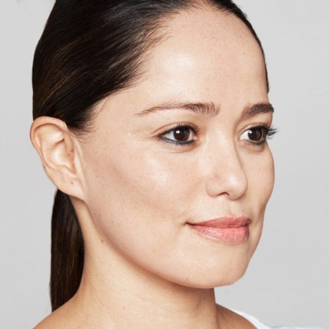 Restylane Skinboosters Before and After - Case -1, Image 1 - Female, age 35 – 44 - Montréal & Saint-Sauveur, QC - Clinique AG