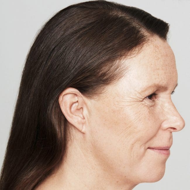 Restylane Skinboosters Before and After - Case 2, Image 2 - Female, age 45 – 54 - Montréal & Saint-Sauveur, QC - Clinique AG