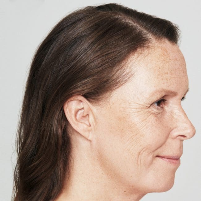 Restylane Skinboosters Before and After - Case 2, Image 1 - Female, age 45 – 54 - Montréal & Saint-Sauveur, QC - Clinique AG