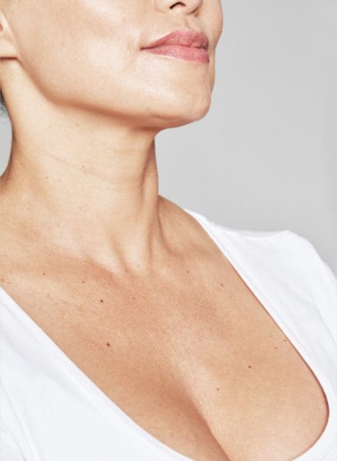 Restylane Skinboosters Before and After - Case 3, Image 2 - Female, age 35 – 44 - Montréal & Saint-Sauveur, QC - Clinique AG