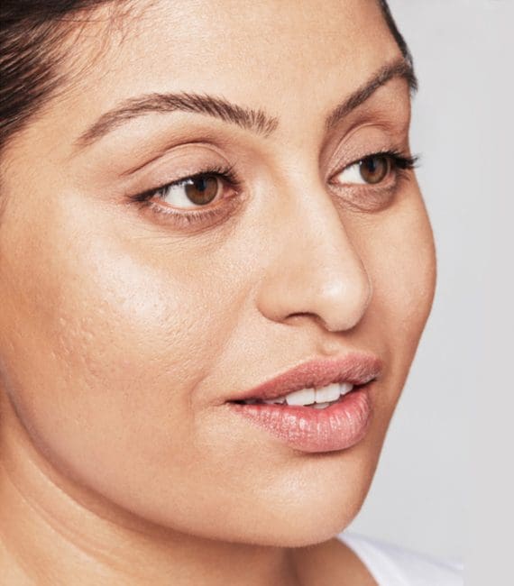 Restylane Skinboosters Before and After - Case 4, Image 2 - Female, age 25 – 34 - Montréal & Saint-Sauveur, QC - Clinique AG