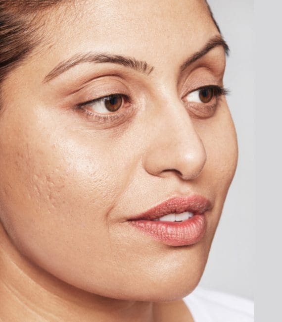 Restylane Skinboosters Before and After - Case 4, Image 1 - Female, age 25 – 34 - Montréal & Saint-Sauveur, QC - Clinique AG