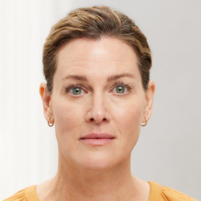 Botox Before & Afters | Clinique AG