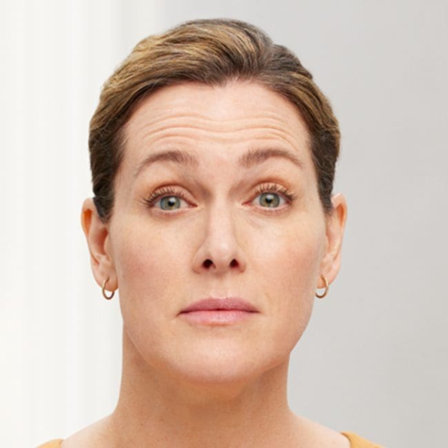 Botox Before & Afters | Clinique AG