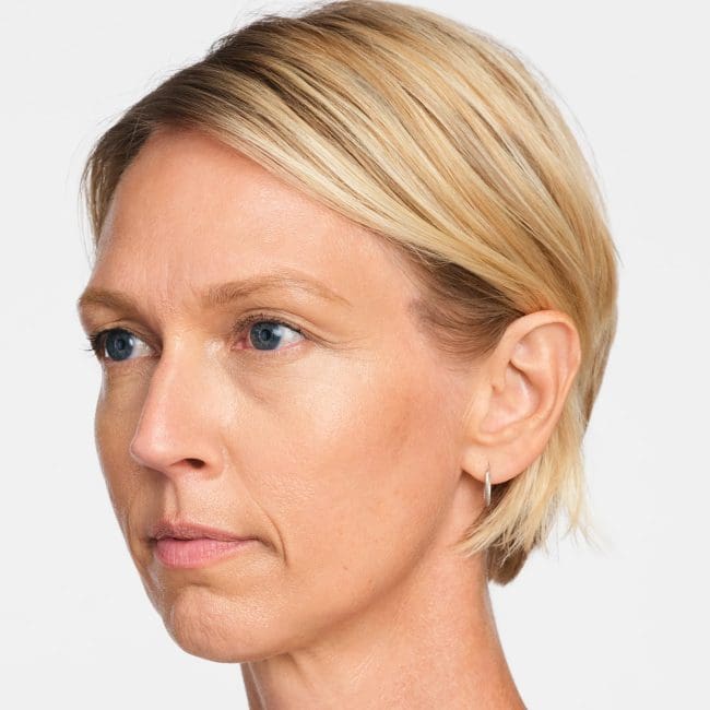 Radiesse Before and After - Case -1, Image 4 - Female, age 45 – 54 - Montréal & Saint-Sauveur, QC - Clinique AG