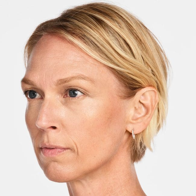 Radiesse Before and After - Case -1, Image 3 - Female, age 45 – 54 - Montréal & Saint-Sauveur, QC - Clinique AG