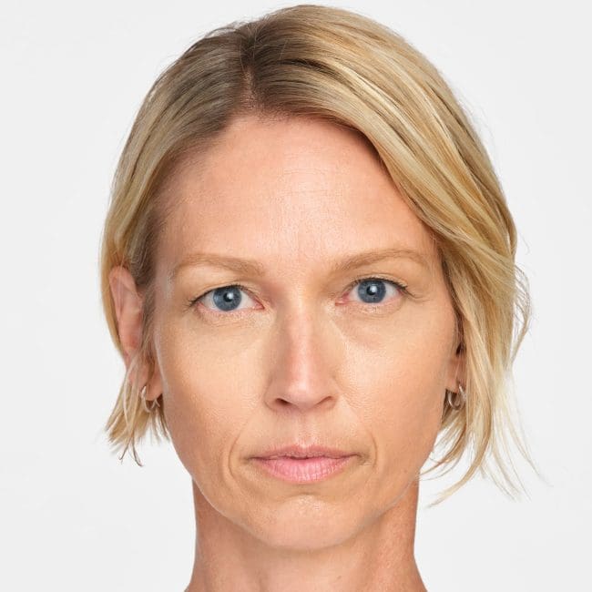 Sculptra Before & Afters | Clinique AG