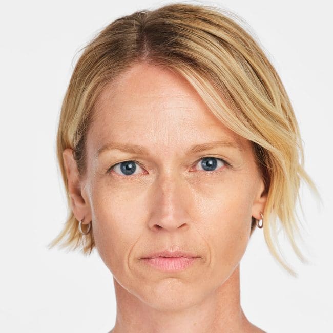 Sculptra Before & Afters | Clinique AG