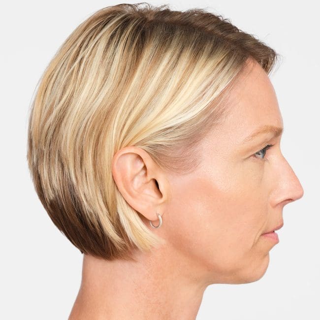 Radiesse Before and After - Case -1, Image 6 - Female, age 45 – 54 - Montréal & Saint-Sauveur, QC - Clinique AG