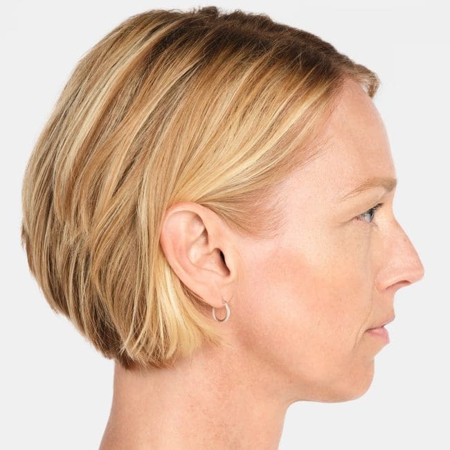 Radiesse Before and After - Case -1, Image 5 - Female, age 45 – 54 - Montréal & Saint-Sauveur, QC - Clinique AG