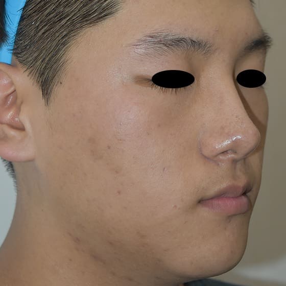 RF Microneedling Before and After - Case 2, Image 2 - Male, age 25 – 34 - Montréal & Saint-Sauveur, QC - Clinique AG