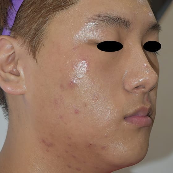 RF Microneedling Before and After - Case 2, Image 1 - Male, age 25 – 34 - Montréal & Saint-Sauveur, QC - Clinique AG