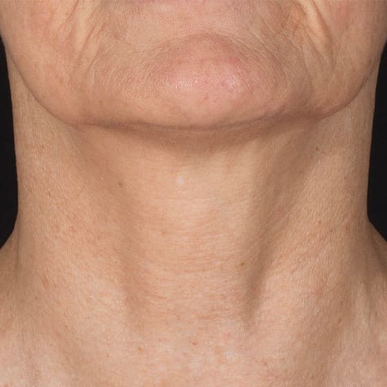 RF Microneedling Before and After - Case -1, Image 2 - Female, age 35 – 44 - Montréal & Saint-Sauveur, QC - Clinique AG