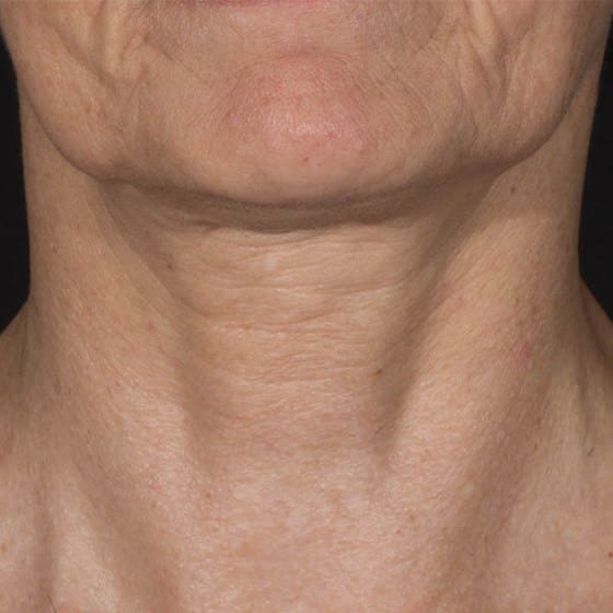 RF Microneedling Before and After - Case -1, Image 1 - Female, age 35 – 44 - Montréal & Saint-Sauveur, QC - Clinique AG