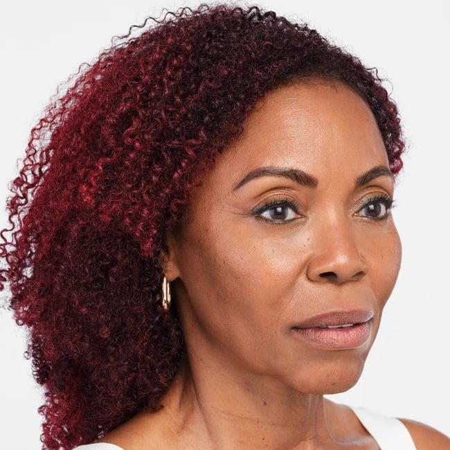 Radiesse Before and After - Case 2, Image 6 - Female, age 55 – 64 - Montréal & Saint-Sauveur, QC - Clinique AG