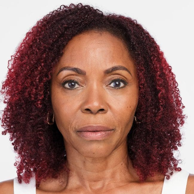 Radiesse Before & Afters | Clinique AG