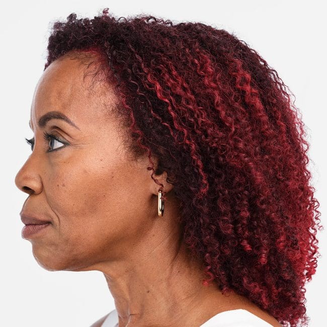 Radiesse Before and After - Case 2, Image 3 - Female, age 55 – 64 - Montréal & Saint-Sauveur, QC - Clinique AG