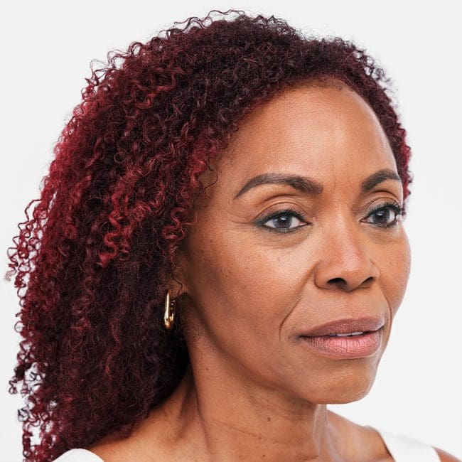 Radiesse Before and After - Case 2, Image 5 - Female, age 55 – 64 - Montréal & Saint-Sauveur, QC - Clinique AG