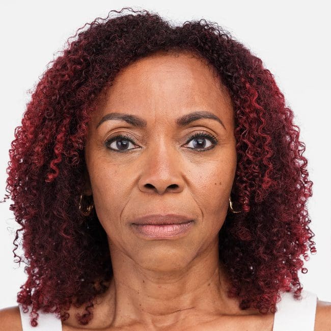 Radiesse Before & Afters | Clinique AG