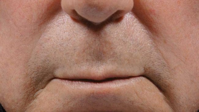 BellaFill Before and After - Case 2, Image 2 - Male, age 45 – 54 - Montréal & Saint-Sauveur, QC - Clinique AG