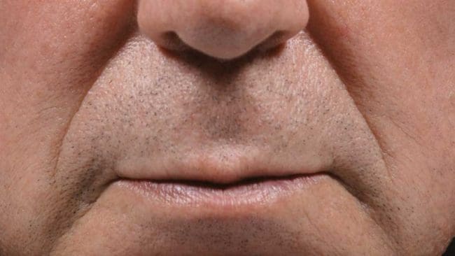 BellaFill Before and After - Case 2, Image 1 - Male, age 45 – 54 - Montréal & Saint-Sauveur, QC - Clinique AG