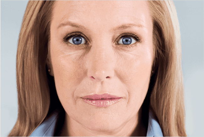 Sculptra Before and After - Case 2, Image 2 - Female, age 45 – 54 - Montréal & Saint-Sauveur, QC - Clinique AG