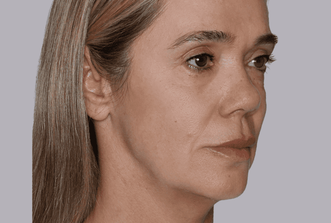 Sculptra Before and After - Case -1, Image 2 - Female, age 45 – 54 - Montréal & Saint-Sauveur, QC - Clinique AG