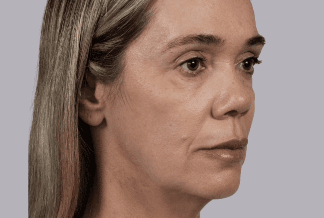 Sculptra Before and After - Case -1, Image 1 - Female, age 45 – 54 - Montréal & Saint-Sauveur, QC - Clinique AG