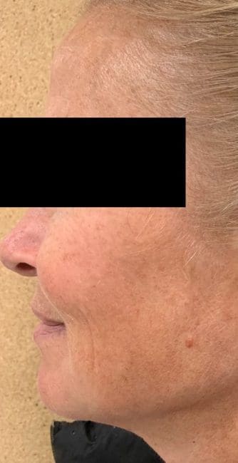 Dermal Fillers Before and After - Case 3, Image 2 - Female, age 45 – 54 - Montréal & Saint-Sauveur, QC - Clinique AG