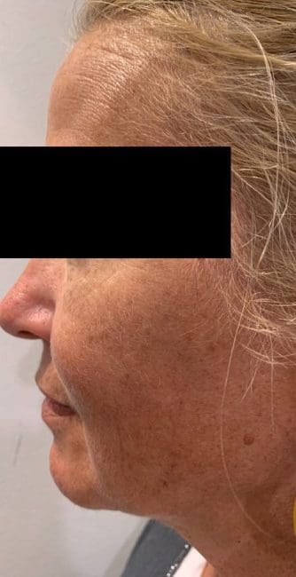 Dermal Fillers Before and After - Case 3, Image 1 - Female, age 45 – 54 - Montréal & Saint-Sauveur, QC - Clinique AG