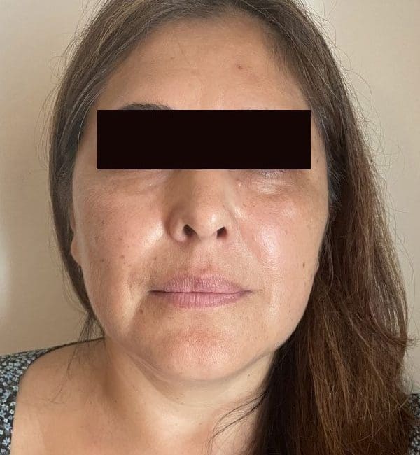 Dermal Fillers Before and After - Case 6, Image 1 - Female, age 45 – 54 - Montréal & Saint-Sauveur, QC - Clinique AG