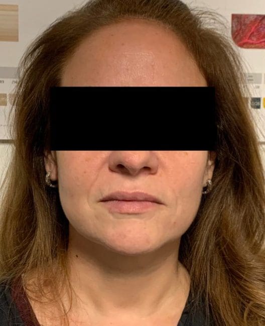 Dermal Fillers Before and After - Case 4, Image 2 - Female, age 35 – 44 - Montréal & Saint-Sauveur, QC - Clinique AG