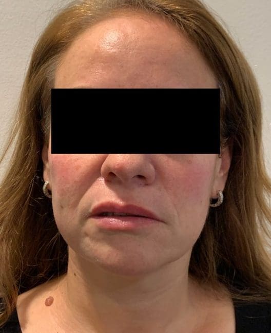 Dermal Fillers Before and After - Case 4, Image 1 - Female, age 35 – 44 - Montréal & Saint-Sauveur, QC - Clinique AG
