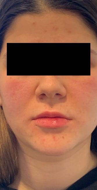 Dermal Fillers Before and After - Case -1, Image 2 - Female, age 25 – 34 - Montréal & Saint-Sauveur, QC - Clinique AG