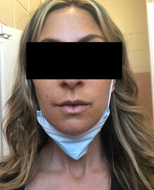 Dermal Fillers Before and After - Case 5, Image 2 - Female, age 45 – 54 - Montréal & Saint-Sauveur, QC - Clinique AG
