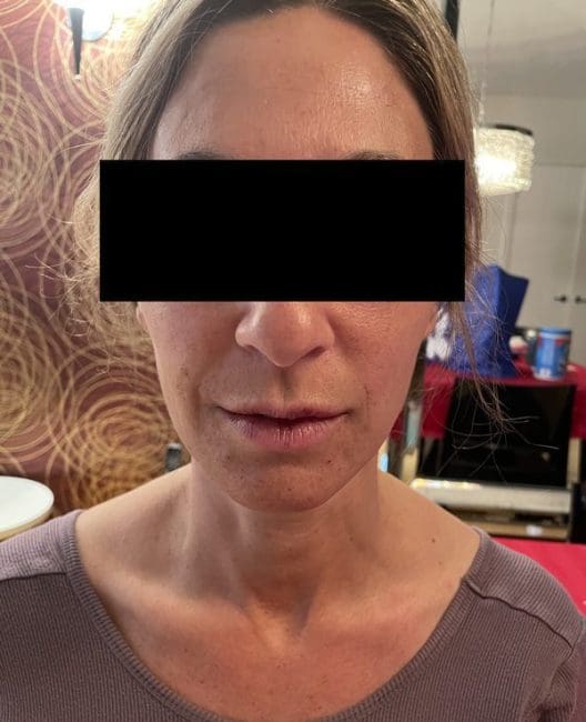 Dermal Fillers Before and After - Case 5, Image 1 - Female, age 45 – 54 - Montréal & Saint-Sauveur, QC - Clinique AG