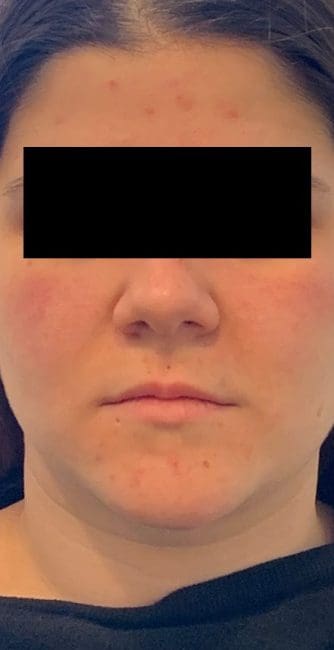 Dermal Fillers Before and After - Case -1, Image 1 - Female, age 25 – 34 - Montréal & Saint-Sauveur, QC - Clinique AG