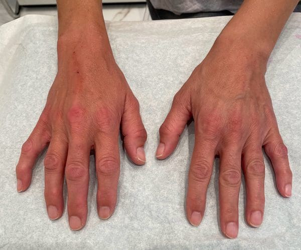 Restylane Skinboosters Before and After - Case 6, Image 2 - Female, age 45 – 54 - Montréal & Saint-Sauveur, QC - Clinique AG