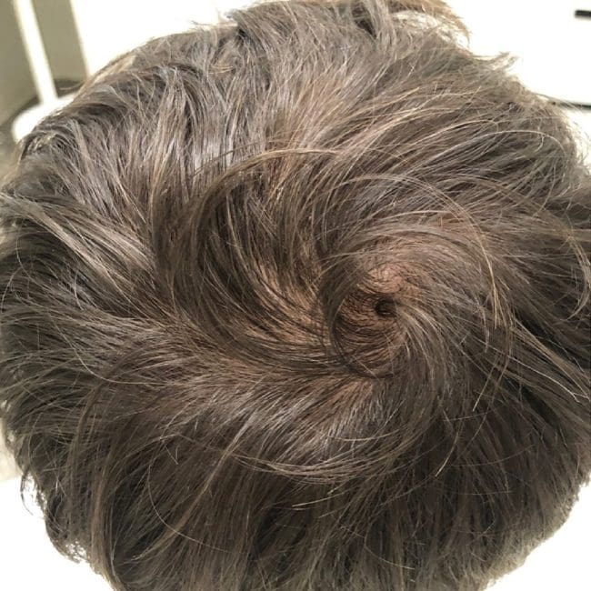 PRP for Hair Loss Before & Afters | Clinique AG
