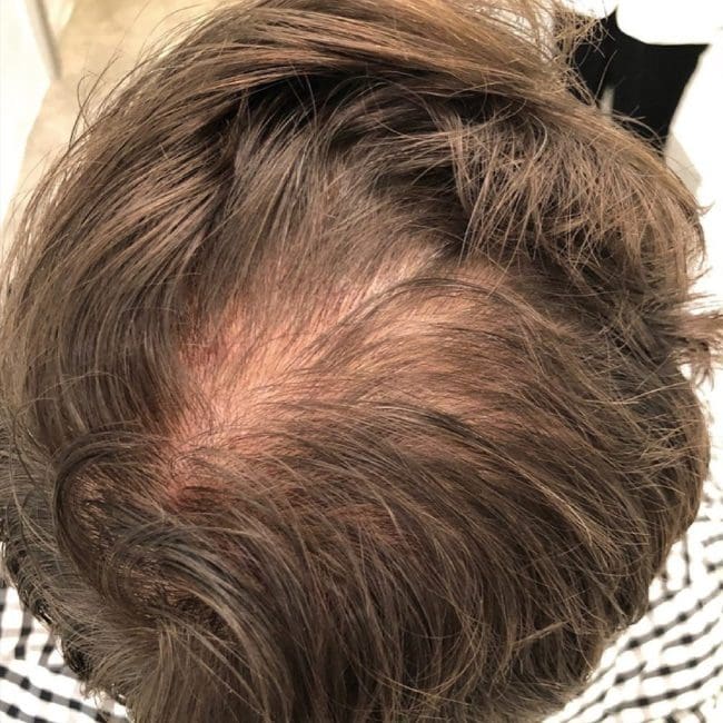 PRP for Hair Loss Before & Afters | Clinique AG