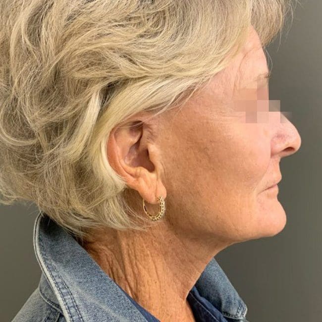 Potenza RF Microneedling Before and After - Case 2, Image 2 - Female, age 55 – 64 - Montréal & Saint-Sauveur, QC - Clinique AG