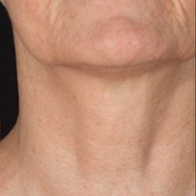 Potenza RF Microneedling Before and After - Case 3, Image 2 - Female, age 45 – 54 - Montréal & Saint-Sauveur, QC - Clinique AG