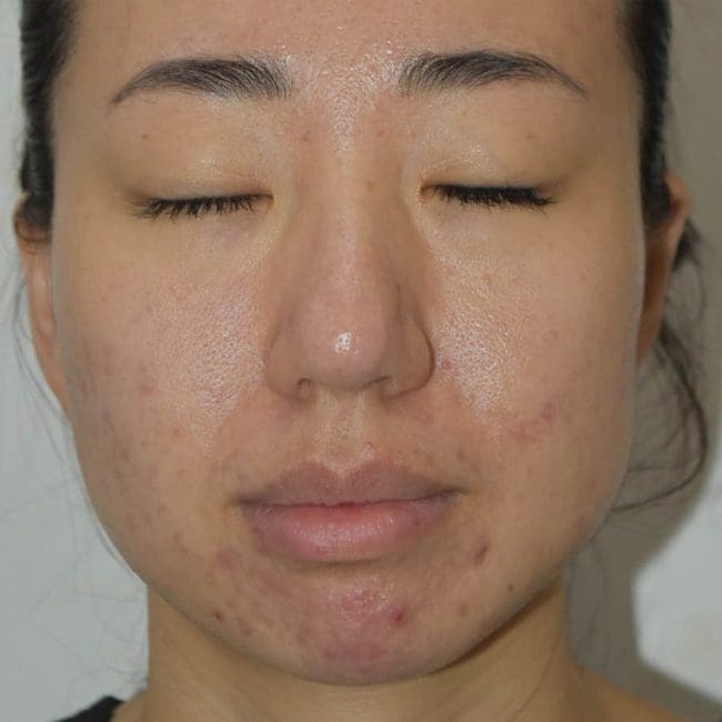Potenza RF Microneedling Before and After - Case 4, Image 2 - Female, age 25 – 34 - Montréal & Saint-Sauveur, QC - Clinique AG